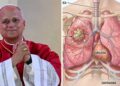 Diagnostican cáncer de pulmón al papa León XIV, le extirpan tumor