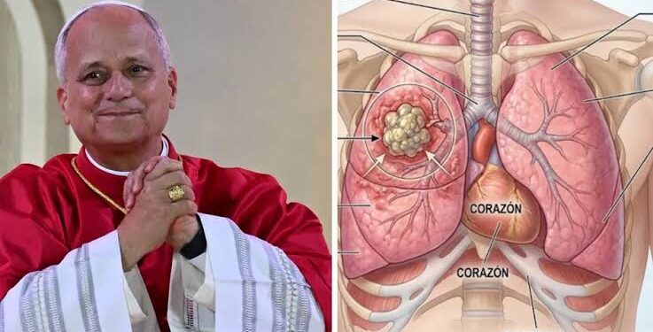 Diagnostican cáncer de pulmón al papa León XIV, le extirpan tumor