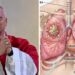 Diagnostican cáncer de pulmón al papa León XIV, le extirpan tumor